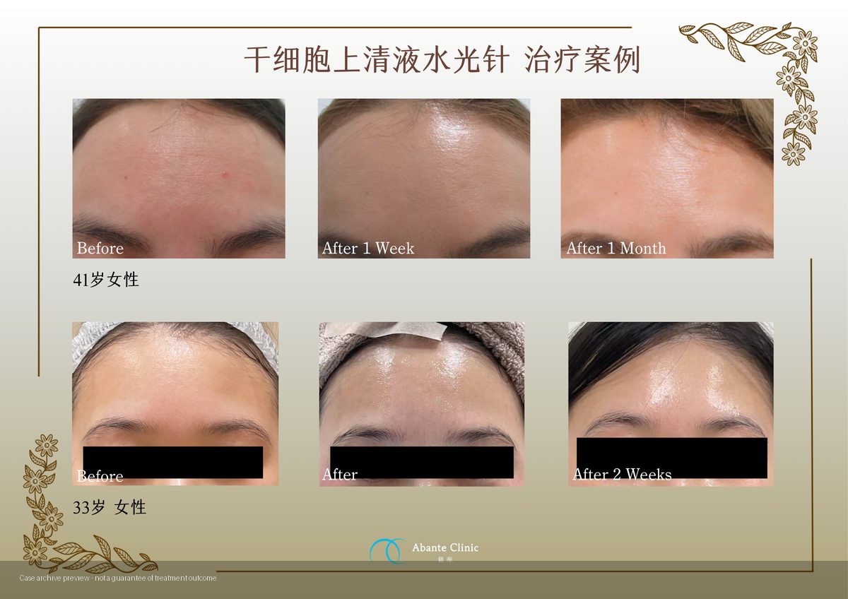 幹細胞上清液水光注射
