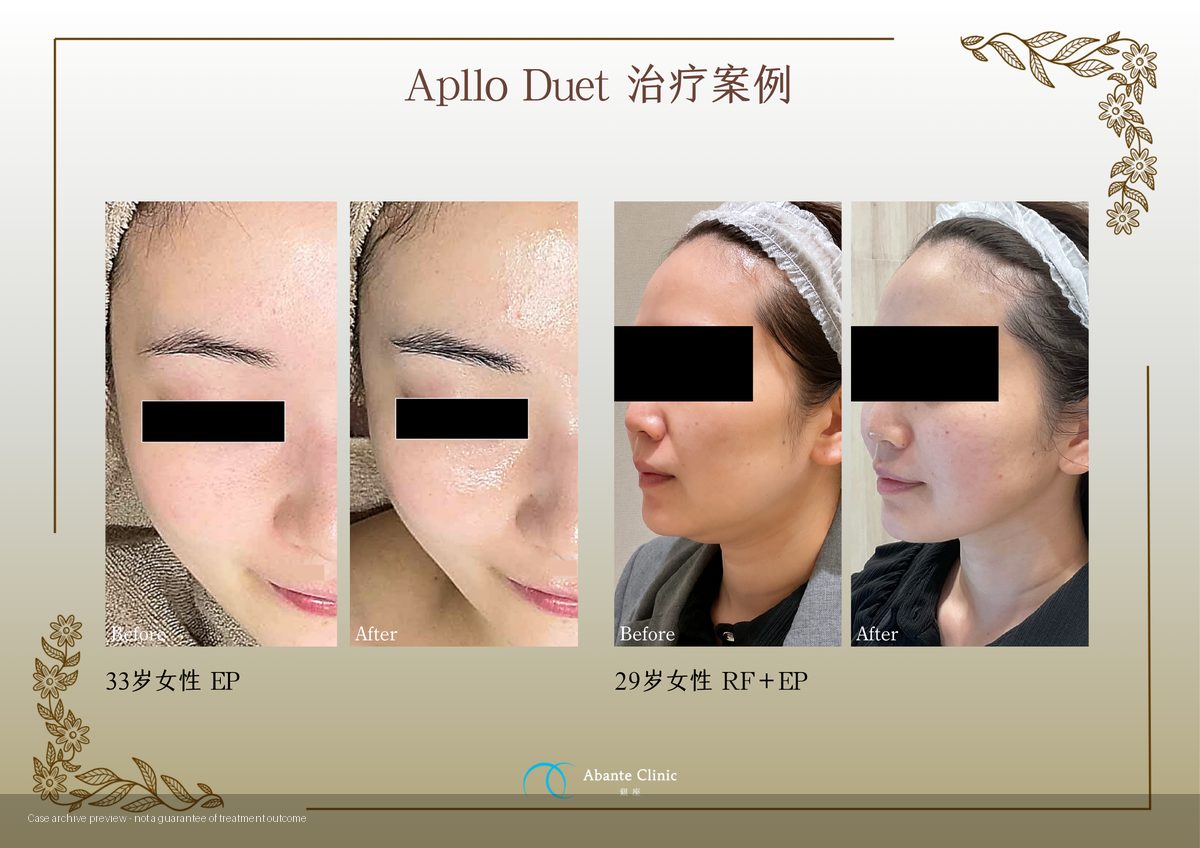 Apollo Duet施術